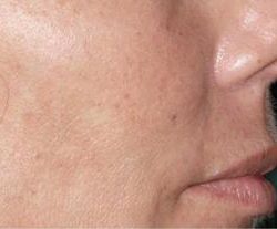 Secret RF Before & After Patient #1621